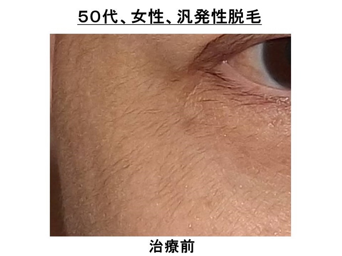 円形脱毛症　病院